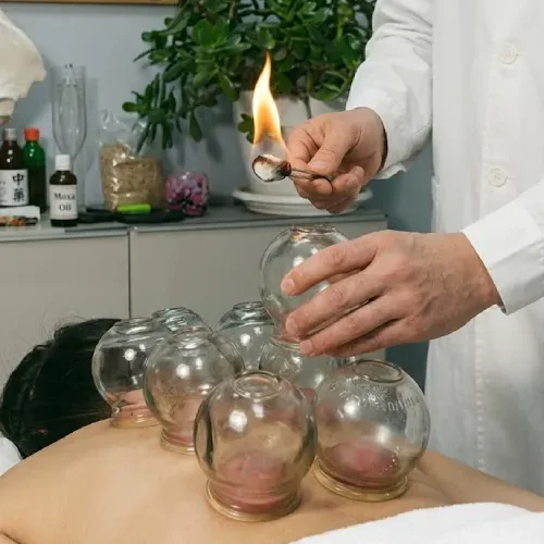 cupping3